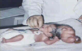 Two-Headed Baby
